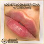 Efekty Warsaw Lips