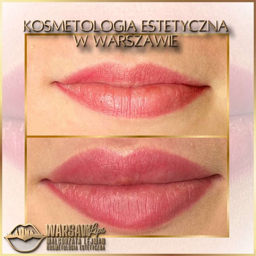 Efekty Warsaw Lips