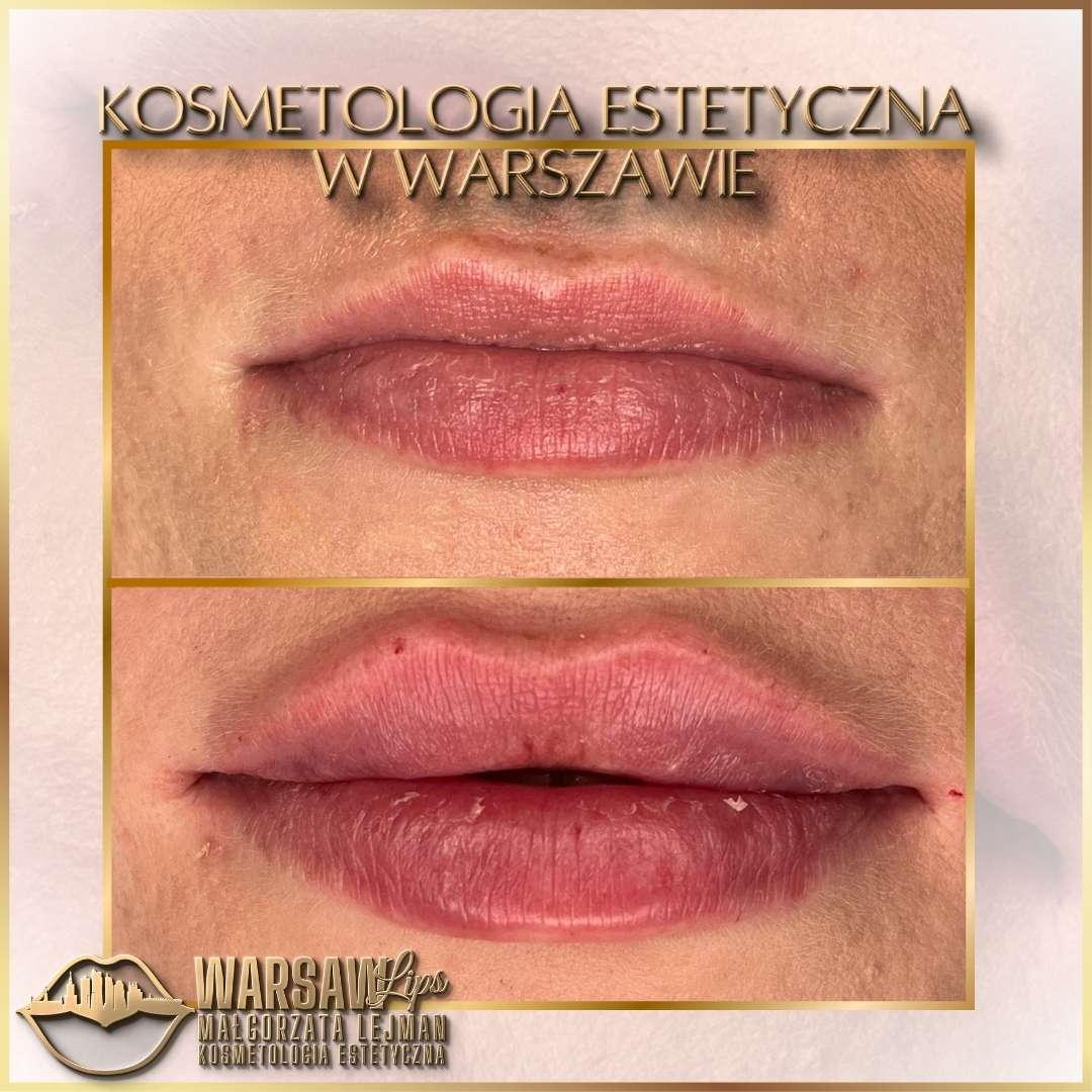 Efekty Warsaw Lips