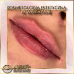 Efekty Warsaw Lips