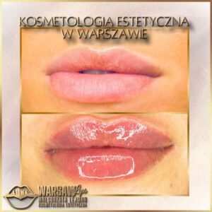 Efekty Warsaw Lips