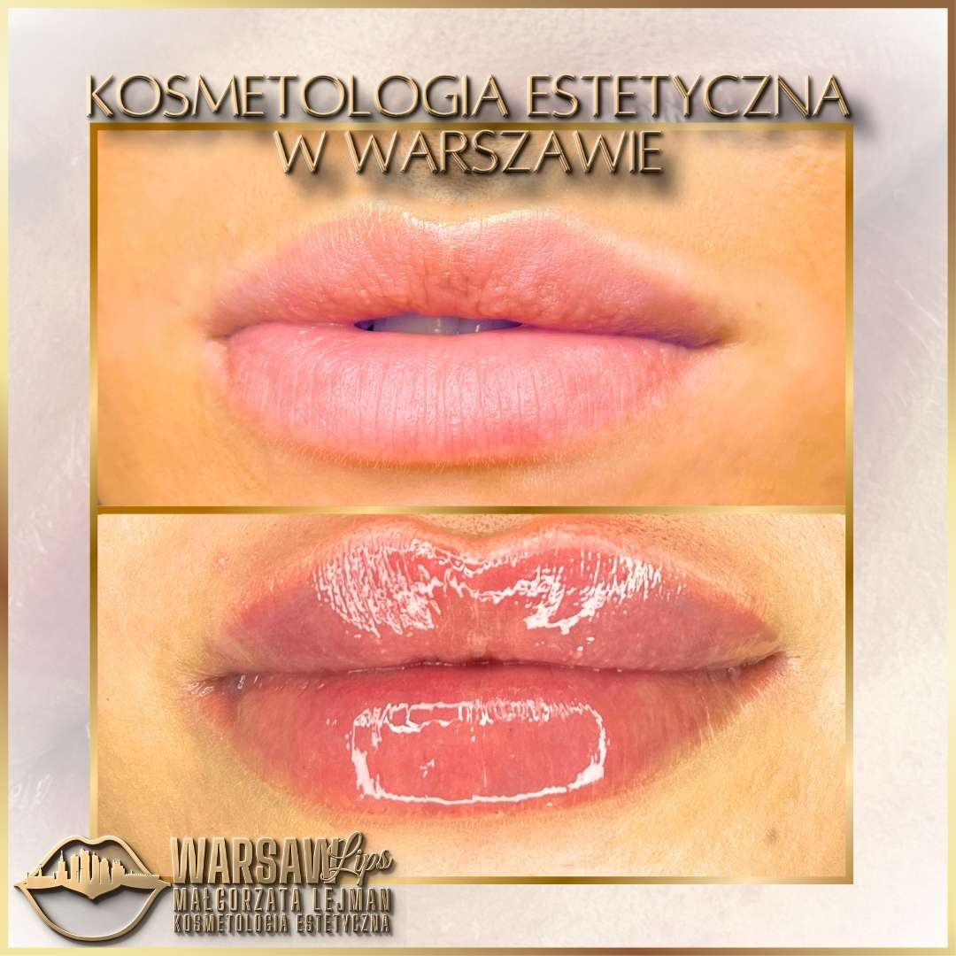 Efekty Warsaw Lips