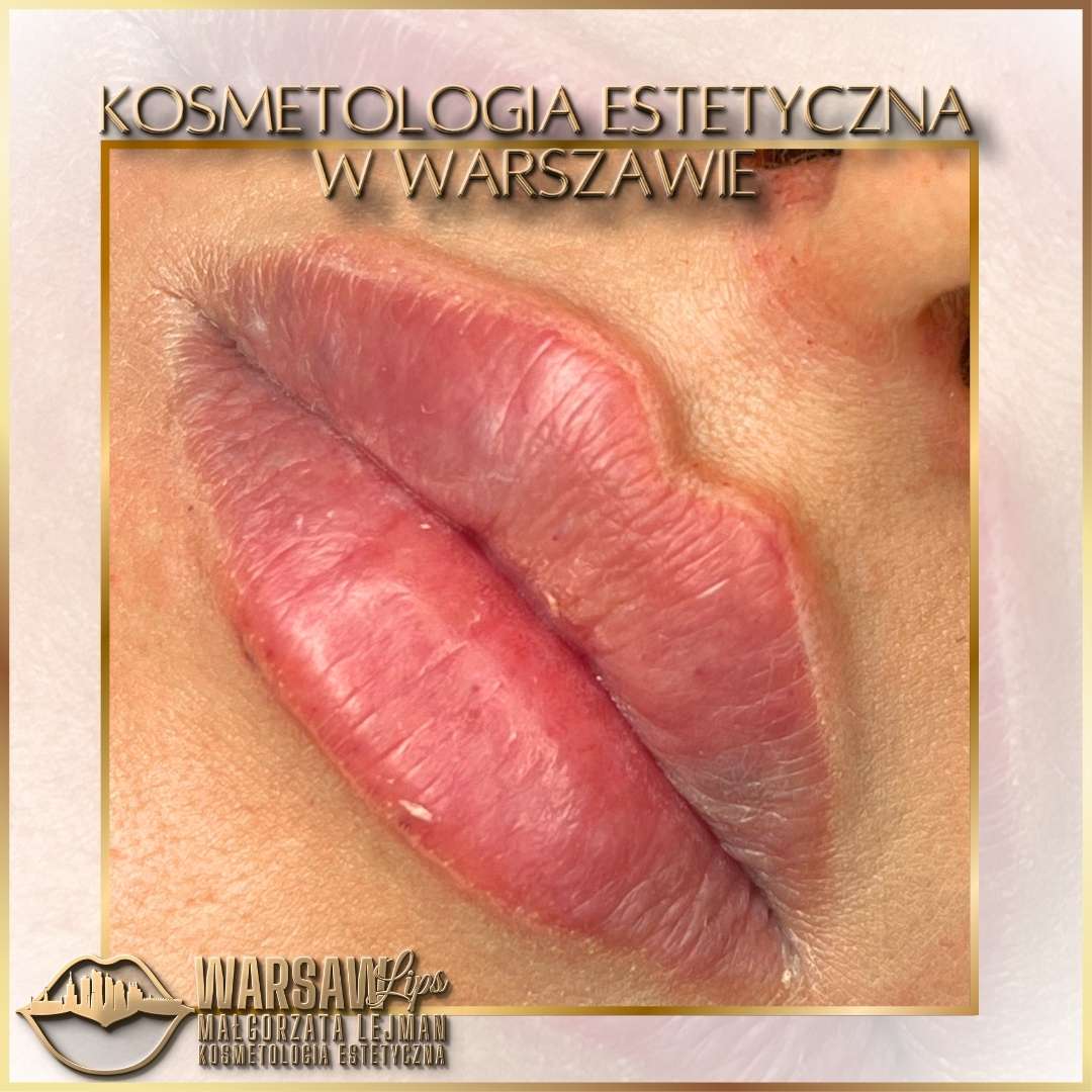 Efekty Warsaw Lips
