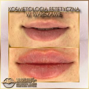 Efekty Warsaw Lips