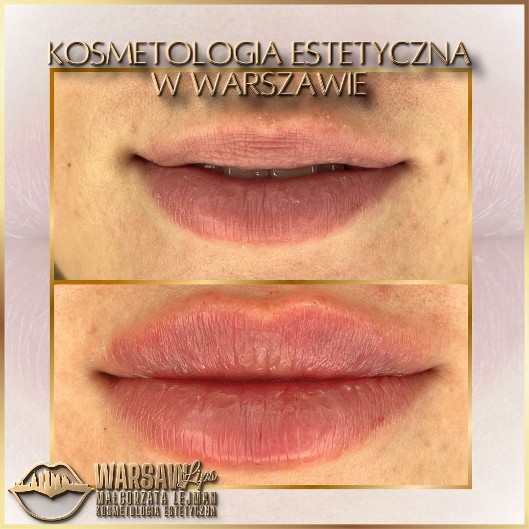 Efekty Warsaw Lips