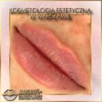 Efekty Warsaw Lips