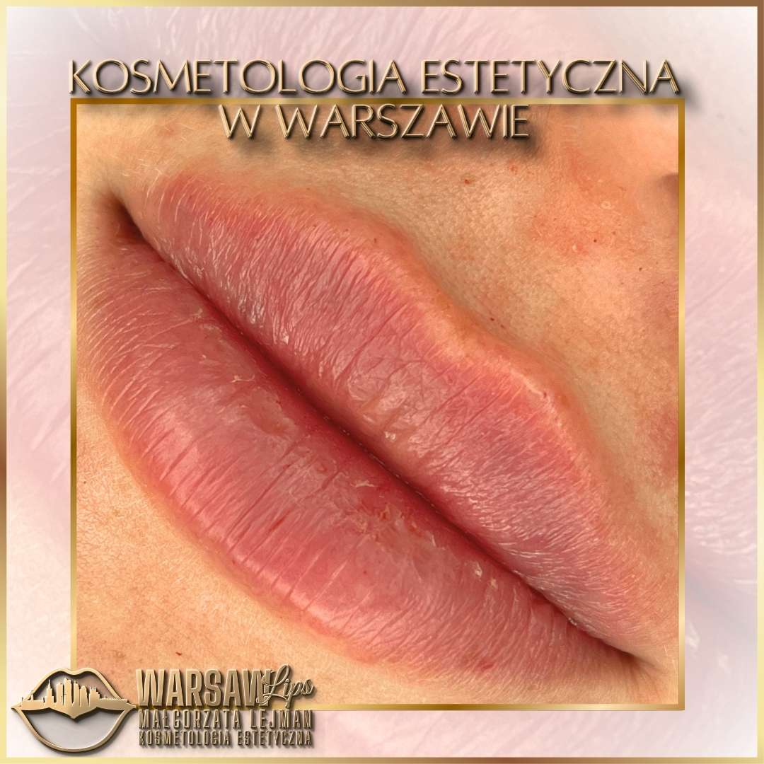 Efekty Warsaw Lips