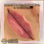 Efekty Warsaw Lips