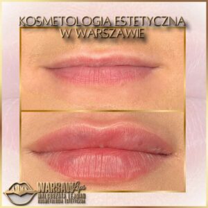 Efekty Warsaw Lips
