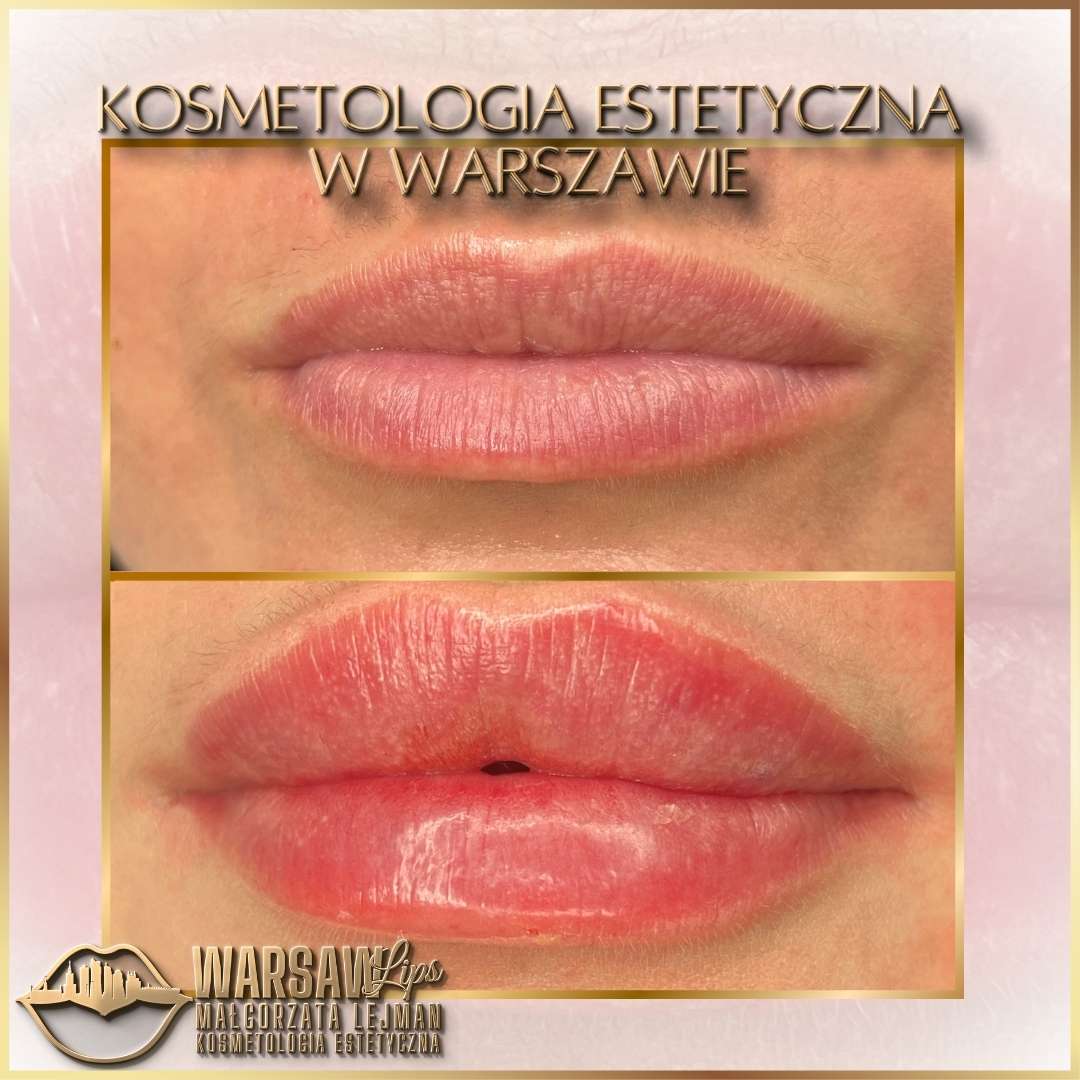 Efekty Warsaw Lips
