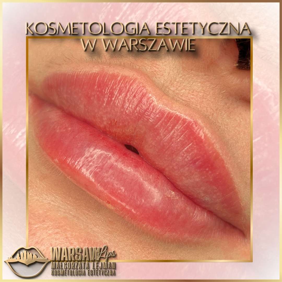 Efekty Warsaw Lips