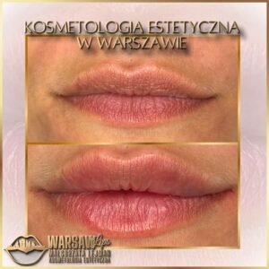 Efekty Warsaw Lips