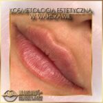 Efekty Warsaw Lips