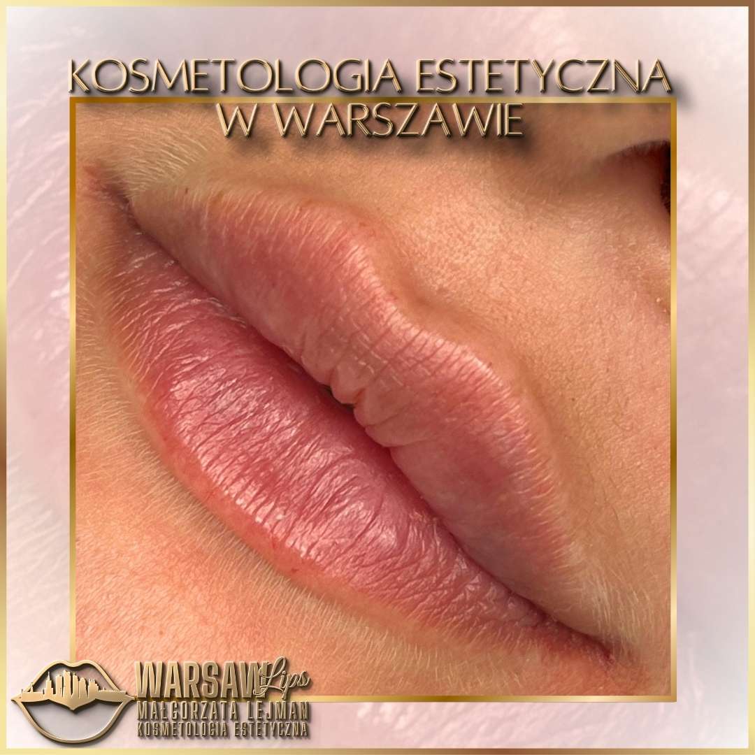 Efekty Warsaw Lips