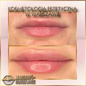 Efekty Warsaw Lips