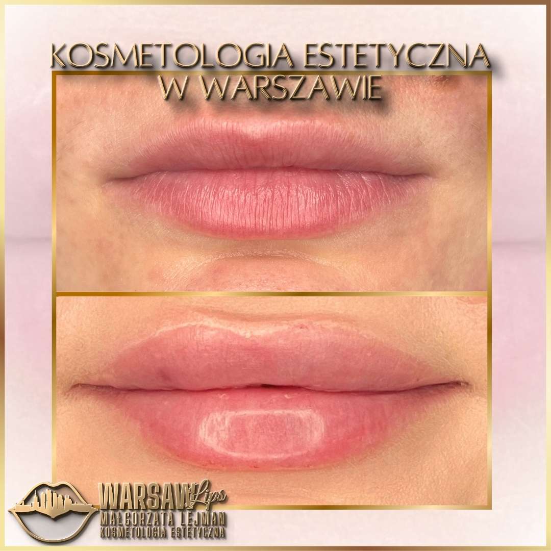 Efekty Warsaw Lips