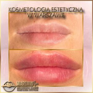 Efekty Warsaw Lips