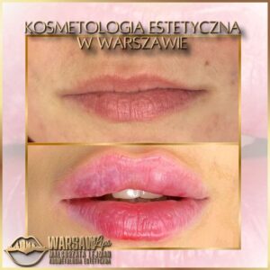 Efekty Warsaw Lips