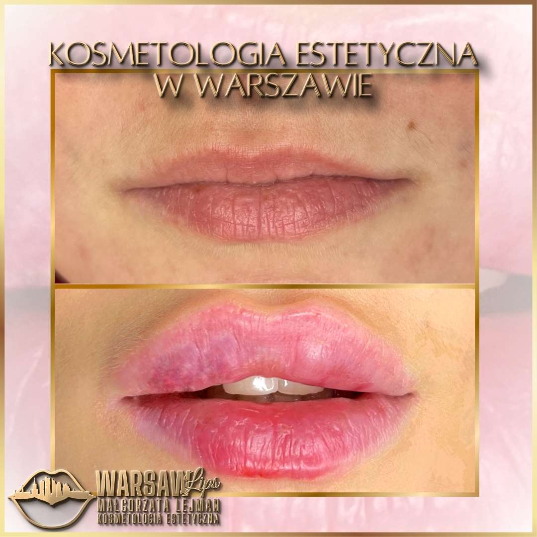 Efekty Warsaw Lips