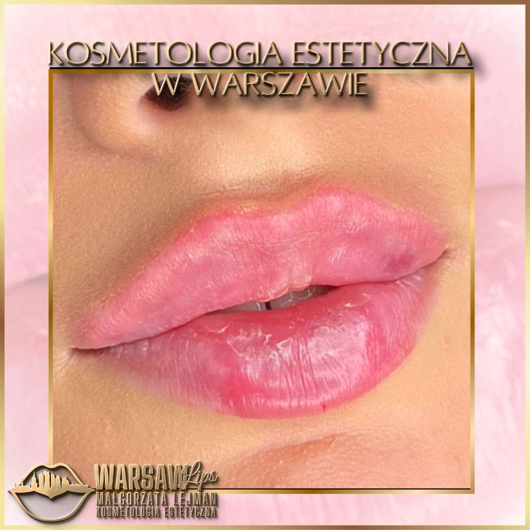 Efekty Warsaw Lips