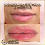 Efekty Warsaw Lips