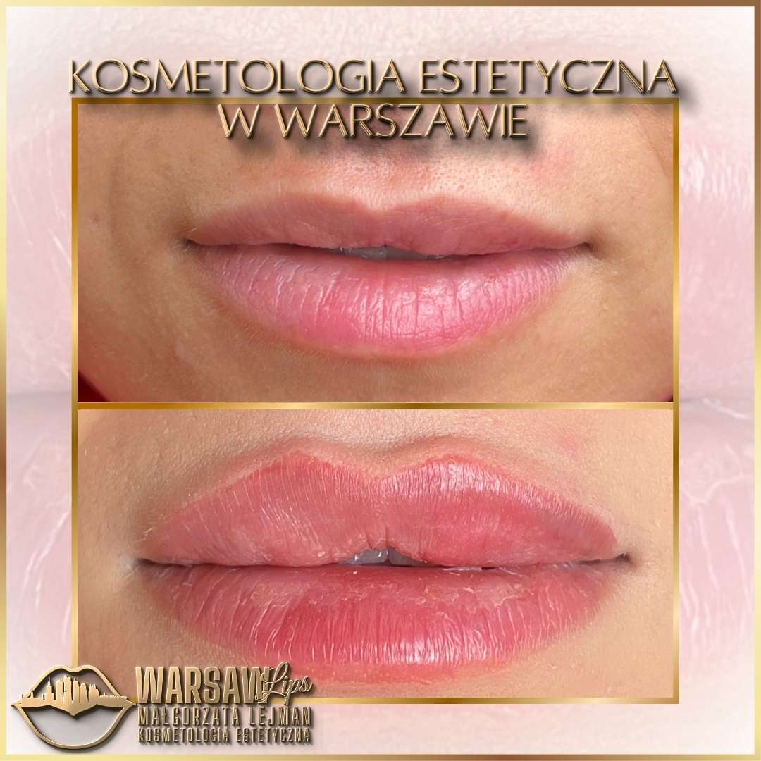 Efekty Warsaw Lips