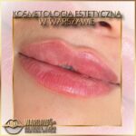 Efekty Warsaw Lips