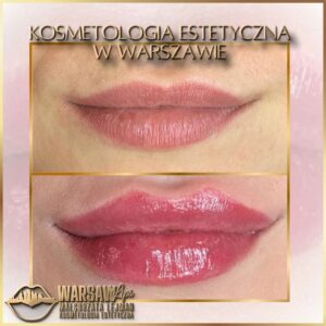 Efekty Warsaw Lips