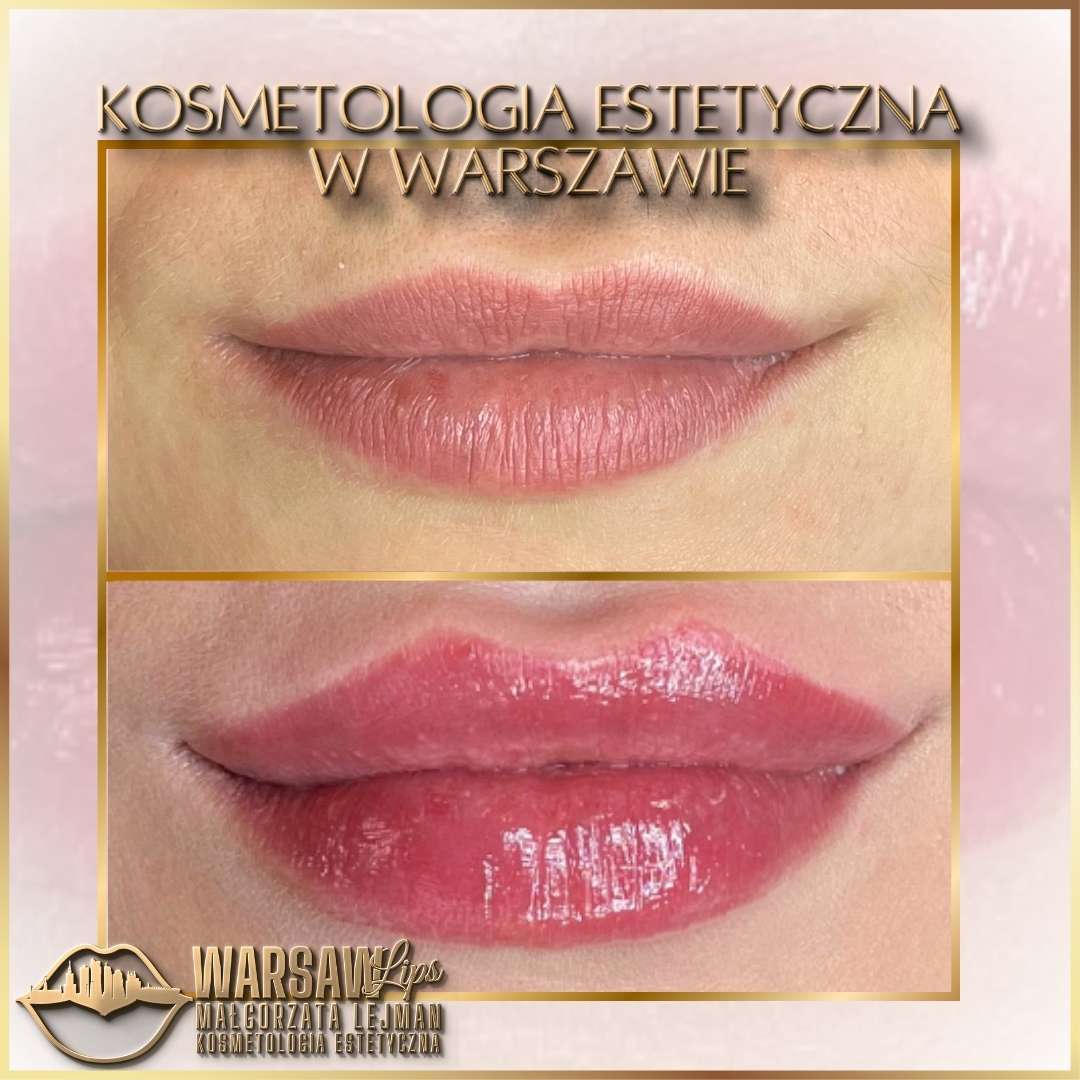 Efekty Warsaw Lips