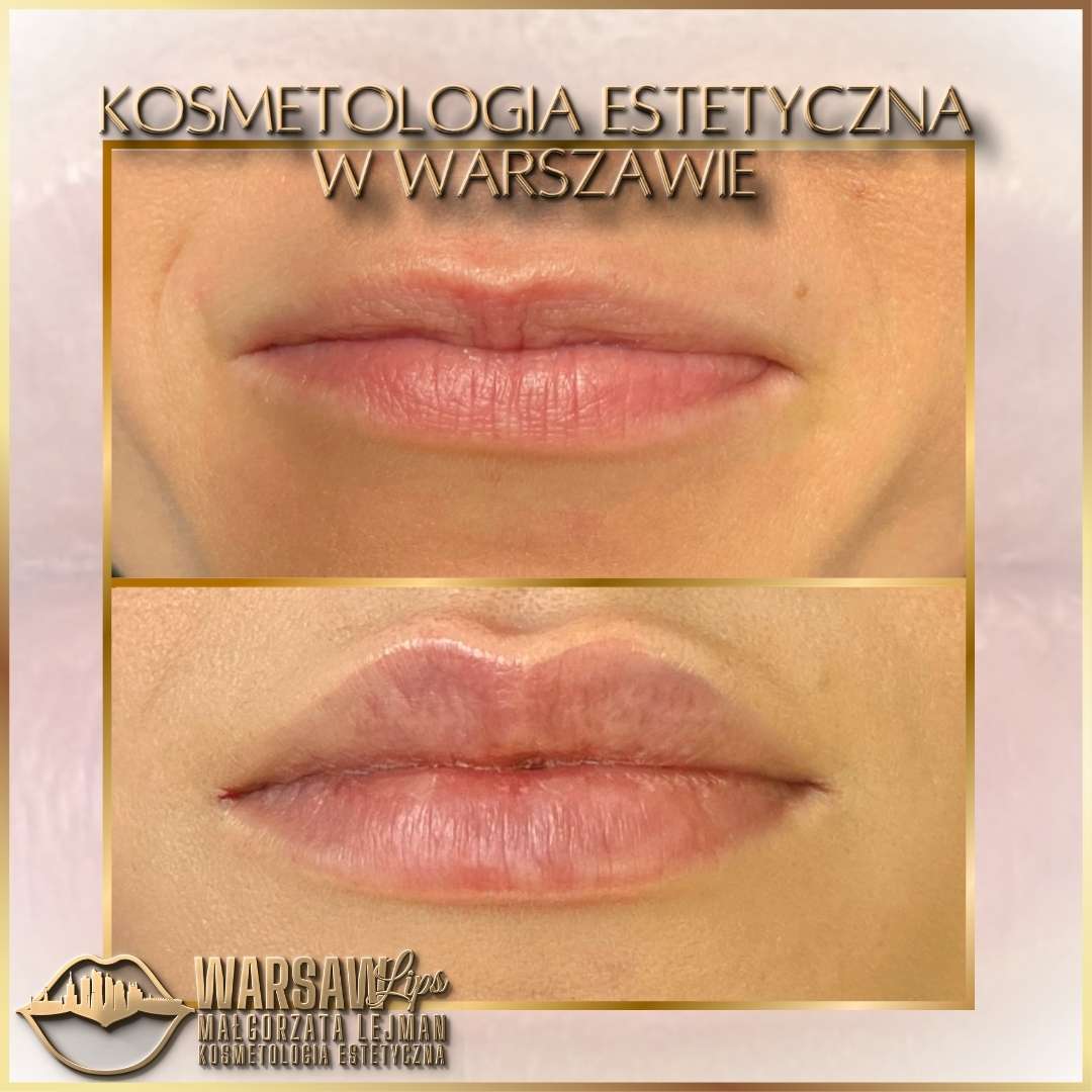 Efekty Warsaw Lips