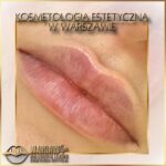 Efekty Warsaw Lips