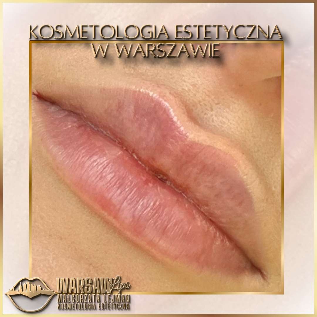 Efekty Warsaw Lips