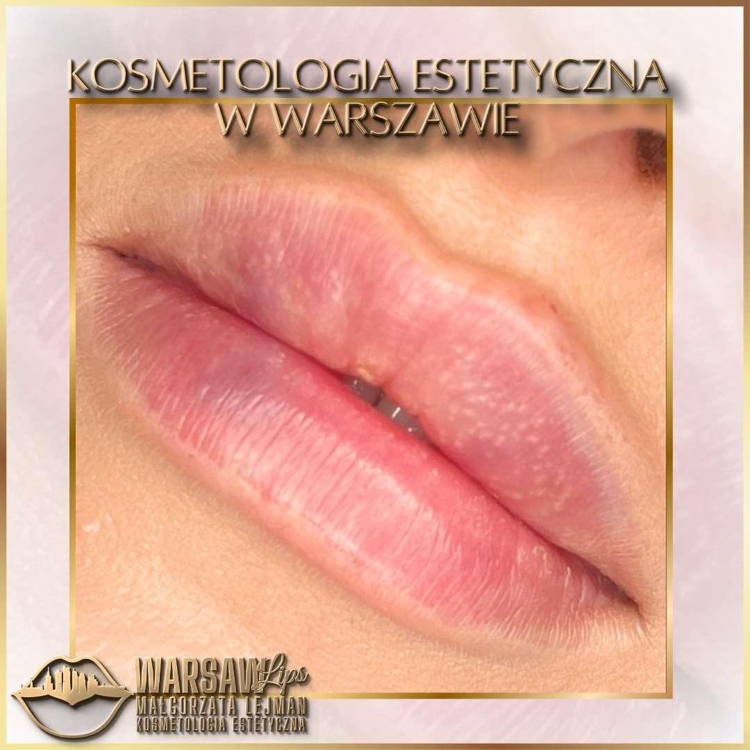 Efekty Warsaw Lips