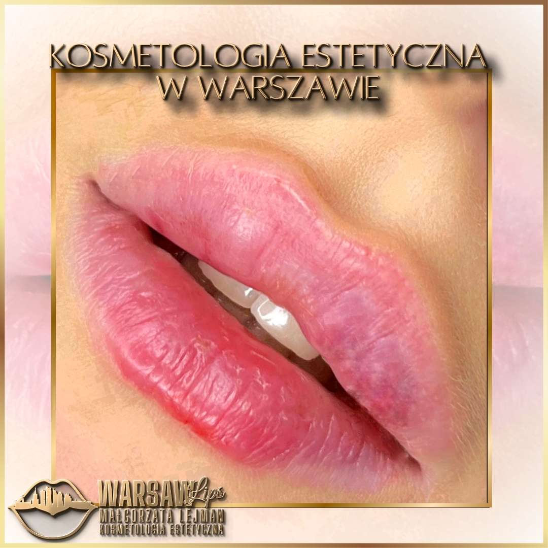 Efekty Warsaw Lips