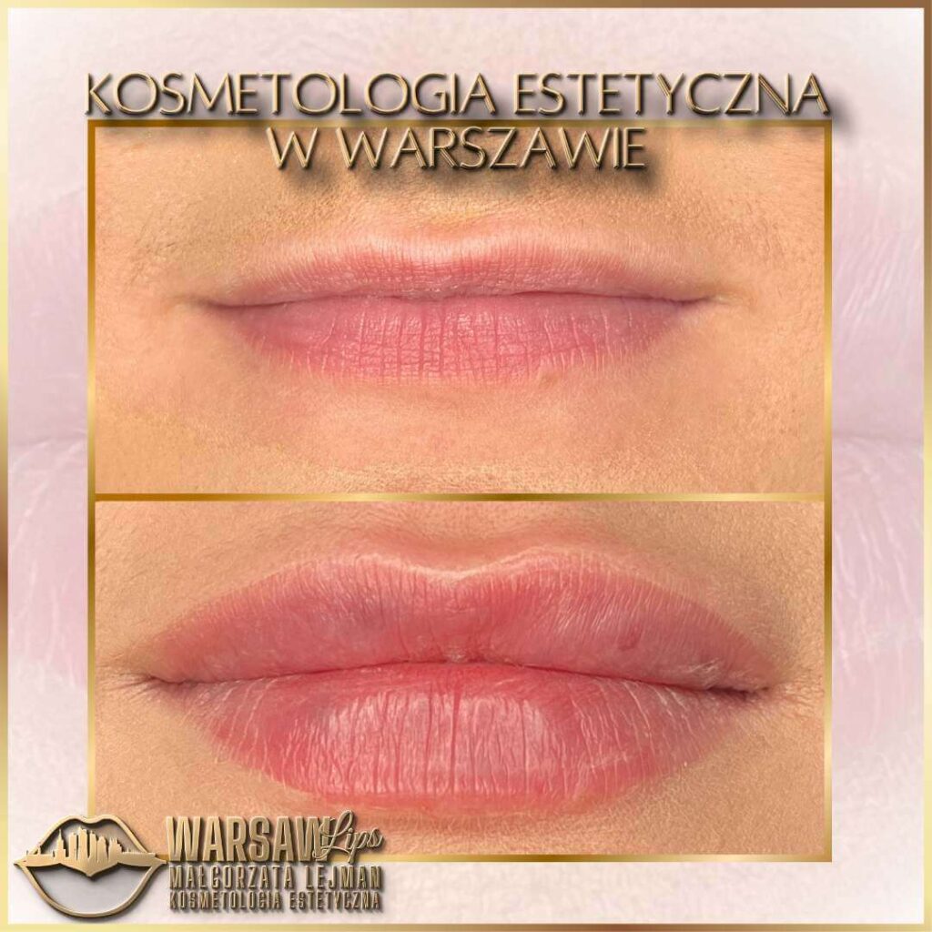 Warsaw Lips - Historia 1 